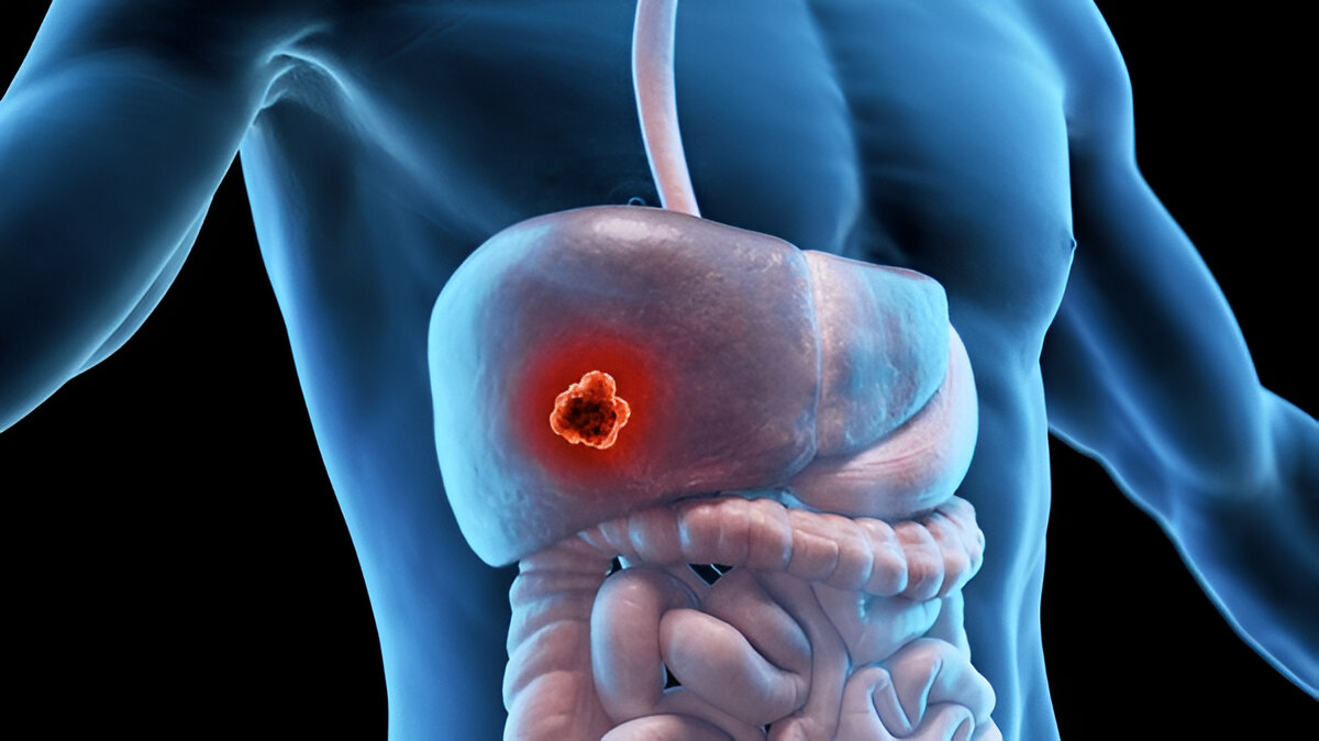 Primary Sclerosing Cholangitis (PSC) Management